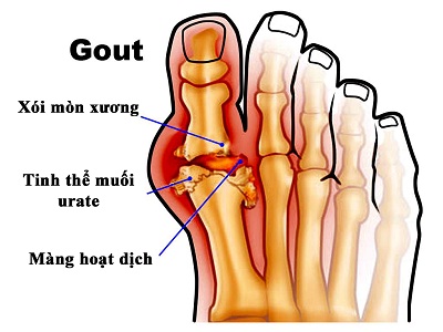 Bệnh Gout là do axit uric trong máu cao hơn chỉ số acid uric bình thường. Việc tăng tăng acid uric máu gây ra đau đớn tại các khớp