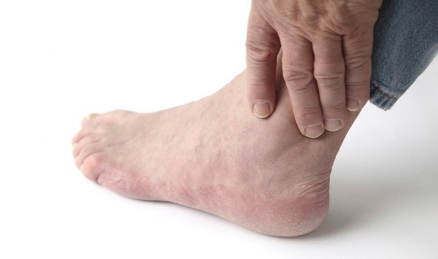 bệnh gout gây đau các ngón chân, tay, đặt biệt là sau khi sử dụng hải sản với bia rượu