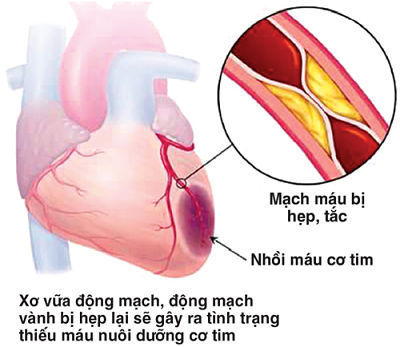 Xơ vữa động mạch có thể xảy ra khi nồng độ acid uric trong máu cao