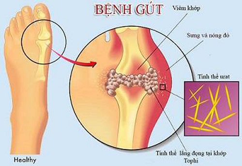Giảm lượng axit uric trong máu – nguyên nhân gây nên bệnh Gout mãn tính