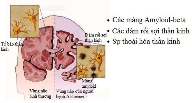 Công dụng đặt biệt của nhụy hoa nghệ tây với bệnh Alzheimer