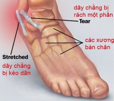 Bong gân cổ chân là loại bong gân phổ biến nhất hiện nay, thường do bất cần trong chơi thể thao hoặc đi lại